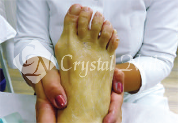 Hatóanyagos lábápolás. Bőrradírral leradírozzuk a lábat, így eltávolítjuk az elhalt hámsejteket, így a hatóanyag jobban bejut a bőrbe.